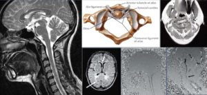 MRI CCS base of skull Fonar-symposium-2013